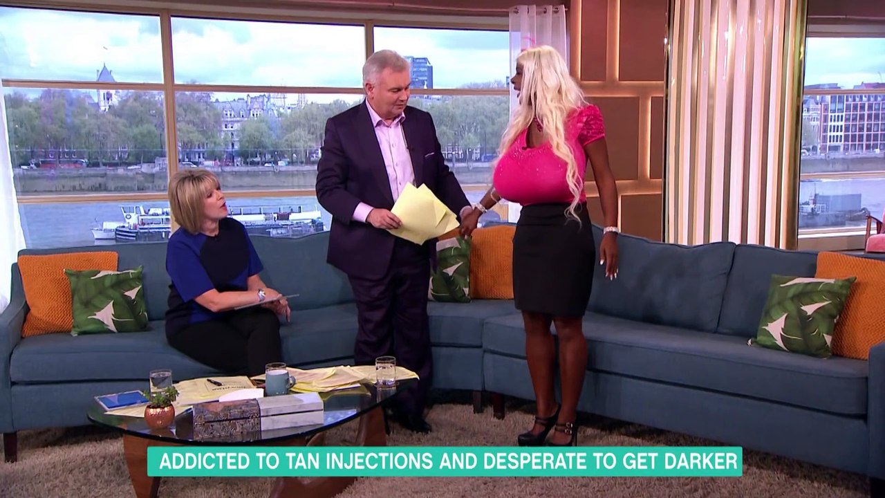 Martina Big s'est fait injecter des pigments pour devenir noire