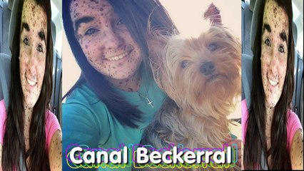 Jovem com 70% do corpo coberto por manchas supera bullying e 'aprende a amar' a própria pele