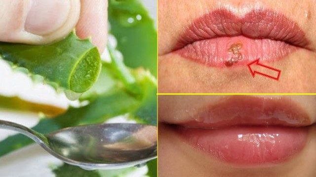 Erupción labial remedios naturales y 6 tratamientos sencillos para el herpes