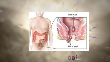 Phòng Khám Điều Trị Bệnh Trĩ Hiệu Quả Tại TPHCM - Phòng Khám Đa Khoa Thế Giới