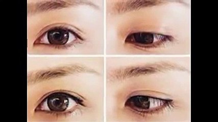 Nhấn mí Hàn Quốc không đau không để lại sẹo