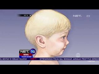 Ini Penjelasan Ilmiah Mengenai Meningitis - NET16