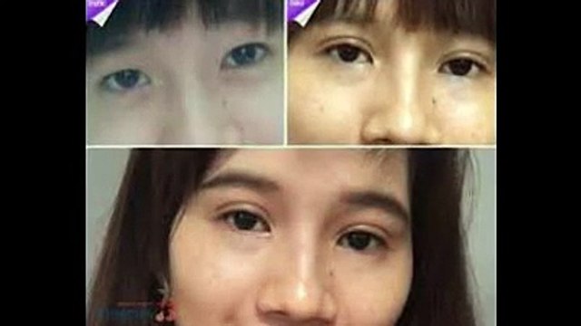 bấm mí hàn quốc bao nhiêu tiền - Thẩm mỹ viện Hà Nội