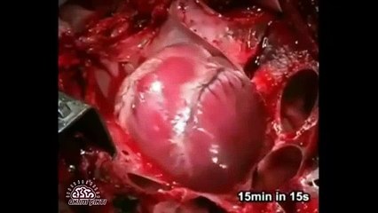 Kalp Krizi Geçirirken Kalp Nasıl Olur?