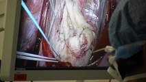 Reportage au bloc opératoire pour une chirurgie cardiaque innovante