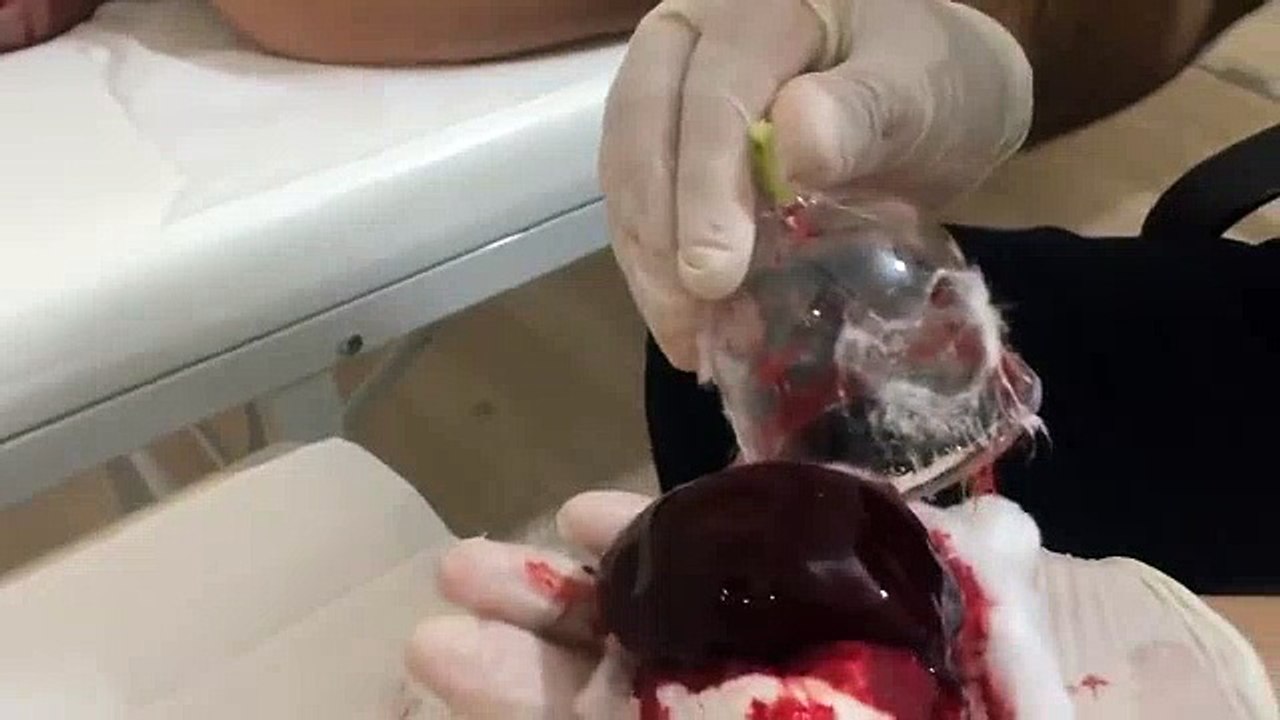 Ağrıları Dindiren Kafa Hacamatı