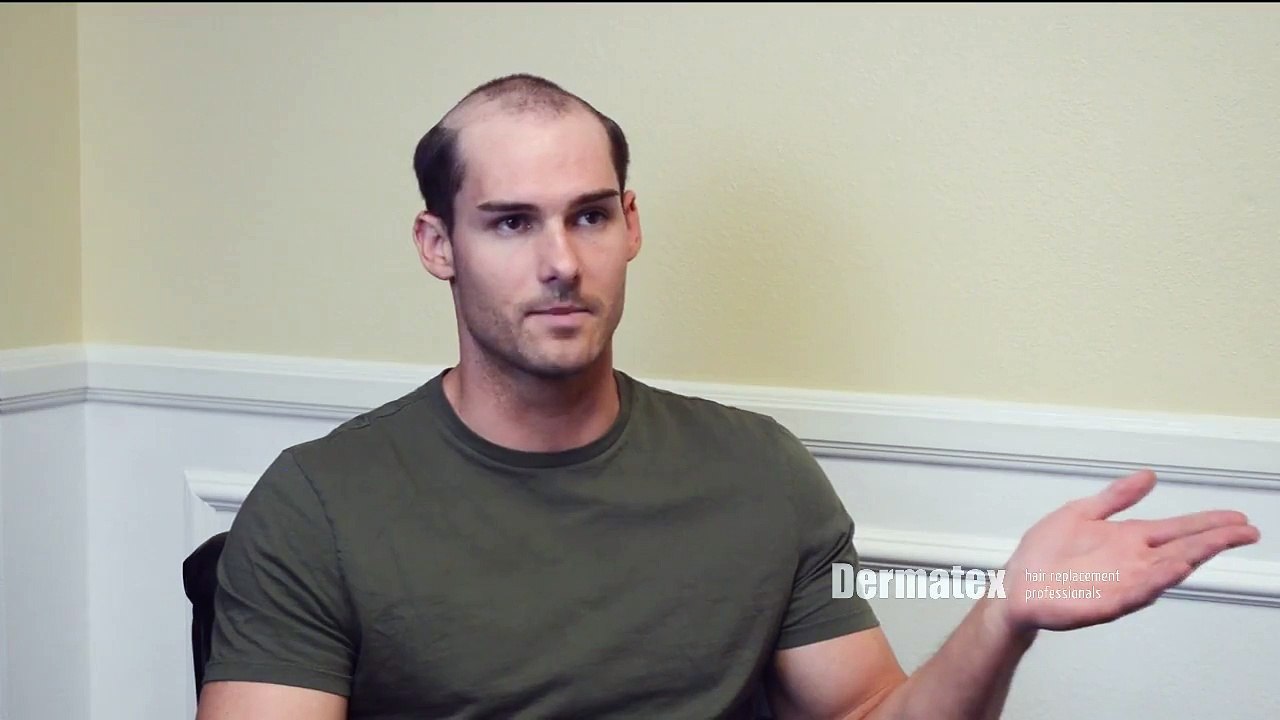 Mens Hair Restoration San Diego Orange County