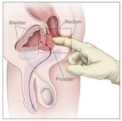 Treatment of prostate cancer-prostatectomy-prevention