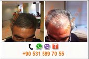 hair transplant in turkey زراعة الشعر في تركيا