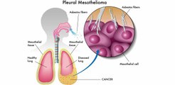 Mesothelioma Causes  Asbestos Exposure Causes Lung Cancer_ Latest Search 2017