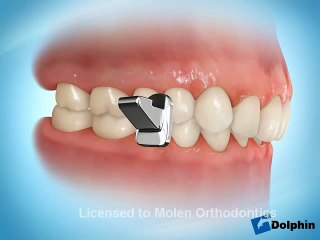 Điều chỉnh hàm bị cong bằng phương pháp niềng răng