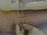 ClozeX, un curioso método para cerrar las heridas sin cicatrices