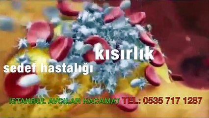 hacamat-ve-suluk-tedavi-merkezi-istanbul-avcilar-0535.717.12.87-hacamat