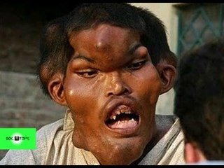 Las 15 Enfermedades Más Extrañas Del Mundo