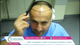 hair transplant cost in turkey hair transplant before and after  German Estetica