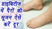 Diabetic Foot Pain | Home remedies | डाइबिटीज़ में पैरों की सूजन ऐसे करें दूर | Boldsky