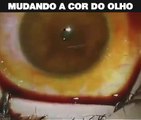 Cirurgia para mudar a cor dos olhos