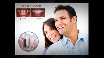 All-On 4 Dental Implants - An Affordable and Permanent Way to Replace a Missing Tooth