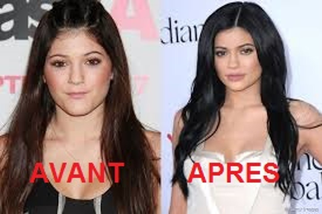 Kylie jenner chirurgie esthétique avant apres transformation