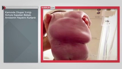 Karnında Oluşan Yırtığı Sırtıyla Kapatan Bebek, Annesinin Hayatını Kurtardı