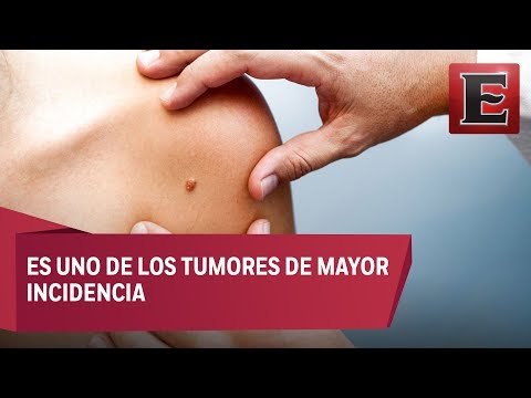 Cáncer de piel: Causas, síntomas y tratamiento