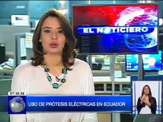 Por primera vez en Ecuador se implementaron prótesis eléctricas