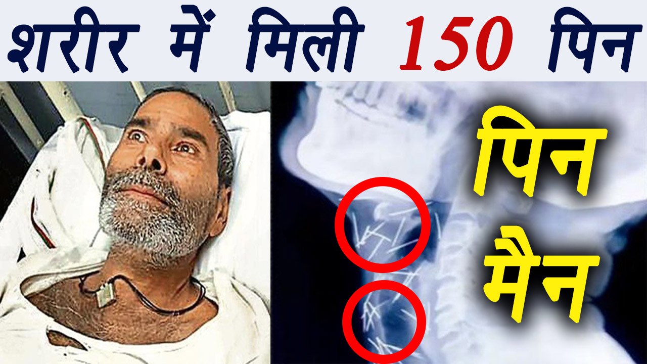 Rajasthan: 100 pins found in man's body; 55 more still there | SHOCKING | वनइंडिया हिंदी