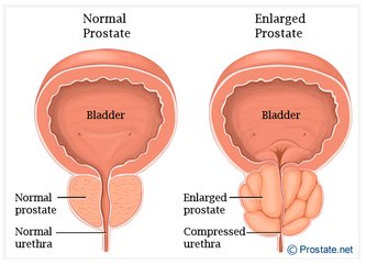 What Are The Symptoms Of Acute Prostatitis?