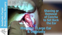 Macrotia Large Ears, Outward Protruding Ears Reduction & Pinning Otoplasty Surgery Live Surgery Demo