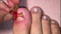 Le moment douloureux où elle se retire un ongle qui s'est décollé suite à un choc