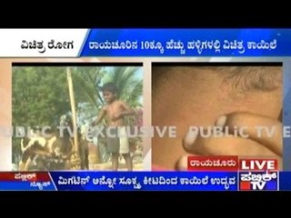 Raichur: Rare Disease Troubles People