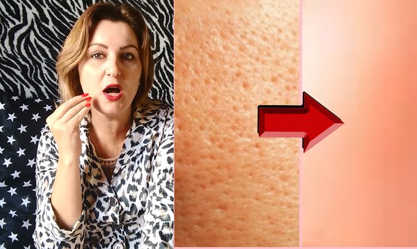 Poros DILATADOS, Como acabar com POROS ABERTOS, PELE com poros ABERTOS receita caseira