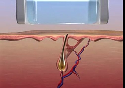 Key benefits to using laser hair removal Chicago, Orland park, Oak Brook