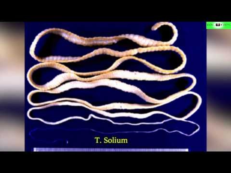 Top 10 Parásitos Asesinos Que Podrían Vivir Dentro De Ti