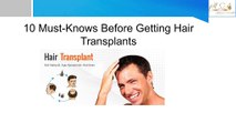 10 Must-Knows Before Getting Hair Transplants
