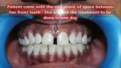 Smile Makeover Treatment in India _ Dentist in Chennai