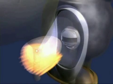 Лечение рака простаты в Израиле. HIFU