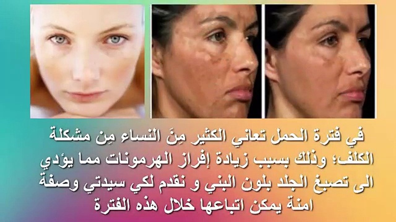 وصفة طبيعية للتخلص من الكلف للمرأة الحامل من خبيرة التجميل غزلان مكوار