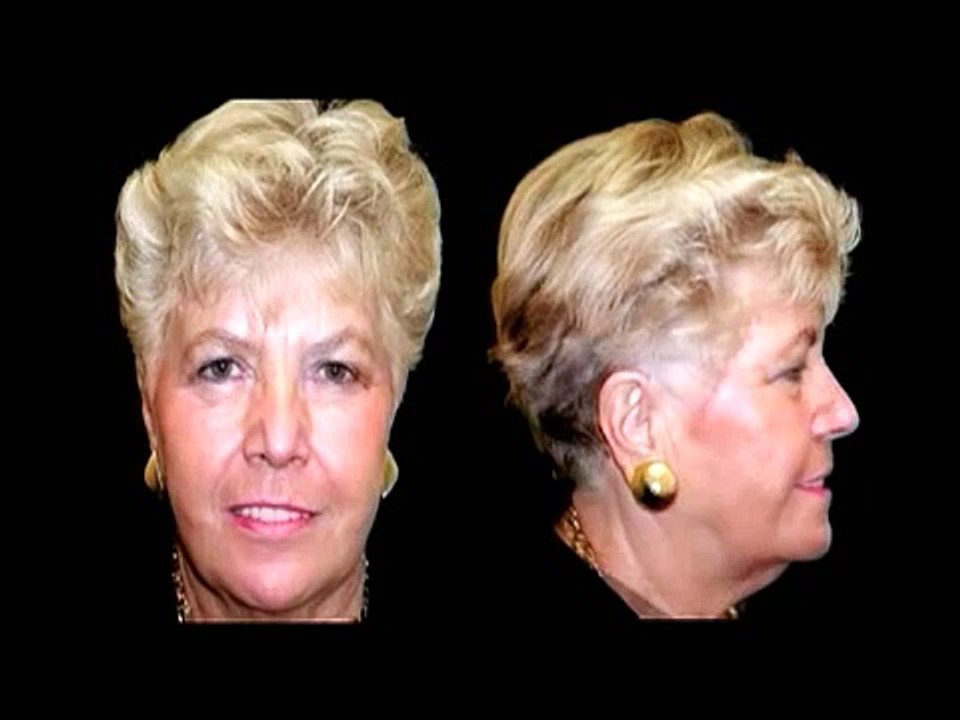 Nobel Biocare Implants in Chennai