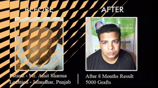 Hair Transplant Result - FUE 5000 grafts at FCHTC Clinic Ludhiana