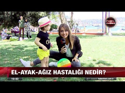 Çocuklarda el-ayak-ağız hastalığı! - 12 temmuz 2017