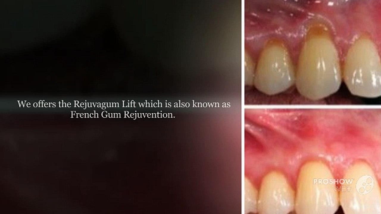 Affordable Gum Recession