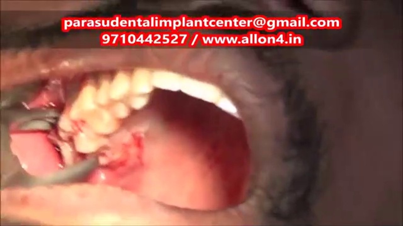 Wisdom Tooth Extraction Video _ Dentist in Chennai