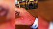 Man Suffers Horrific Burns After Cooking with Limes, Going Out in the Sun