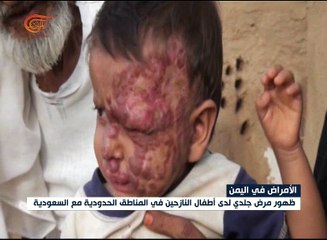 أمراض جلدية غريبة تهاجم النازحين اليمنيين