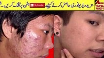 Beauty Tips In Urdu || Remedy To Remove Dark Spots Pigmentation