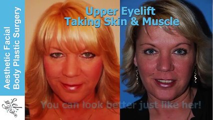 Must see Eyelift Secrets Revealed. Learn the Basics on Browlift, Upper & Lower Eye Lift, Seattle