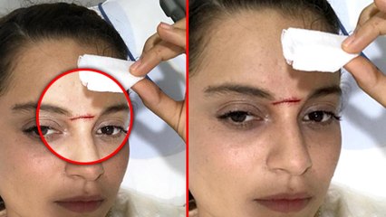 Kangana Ranaut Injured, Rushed To ICCU While Shooting Manikarnika