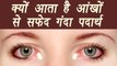 White Discharge from eyes, Know Causes | जानें आंखों से सफेद गंदा पदार्थ निकलने के कारण|Boldsky