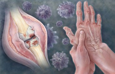 The truth behind cracking your knuckles